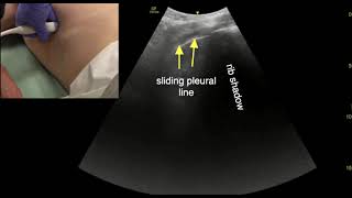 Lung Ultrasound Scanning Techniques [upl. by Chane]