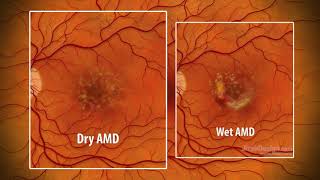 What is agerelated macular degeneration [upl. by Aihsoek]