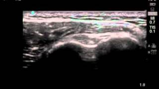 How To Biceps Tendon Ultrasound Exam Scanning Technique [upl. by Giustino303]