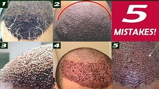 5 Mistakes in a freshly transplanted Hairline [upl. by Rother]