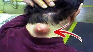 Top 10 Satisfying Pimple Popping Videos [upl. by Adidnac994]