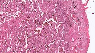 Chronic Pulmonary Congestion  Histopathology [upl. by Shevlo]