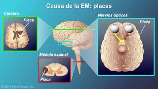 ¿Qué es la Esclerosis Múltiple [upl. by Haisej]