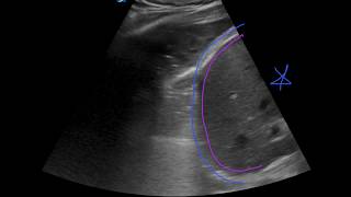 POCUS  Lung Ultrasound Understanding B Lines and Hepatization [upl. by Lomaj319]