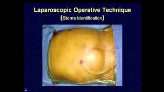 Parastomal Hernia Repair � Best Techniques Kristi Harold MD [upl. by Enialed]