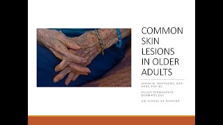 Common Skin Lesions in Older Adults [upl. by Ahsratal]