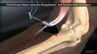 Arthrex Distal Biceps Button Tension Slide Technique [upl. by Seagraves]