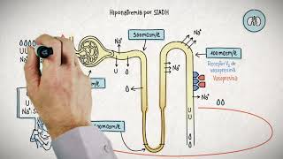 HIPONATREMIA Y SU TRATAMIENTO [upl. by Lukin]