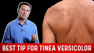 Natural Skin Fungus Tinea Versicolor Home Remedies – Dr Berg [upl. by Aneerak440]