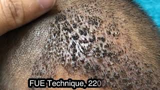 How scalp look after 10th day of Hair Transplant [upl. by Castera]