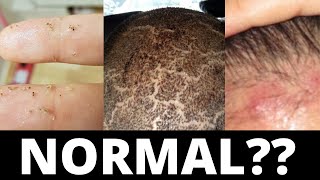 These 3 Things Are Normal After A Hair Transplant [upl. by Nerti985]