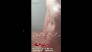 Jugular Venous Pulse Identification [upl. by Thurnau313]