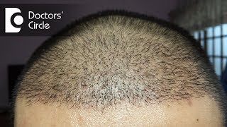 How long does it take for hair to grow after a hair transplant  Dr Madan Kumar BJ [upl. by Hploda901]