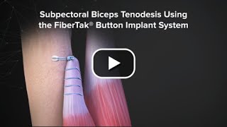 Subpectoral Biceps Tenodesis Using the FiberTak® Button Implant System [upl. by Terese]