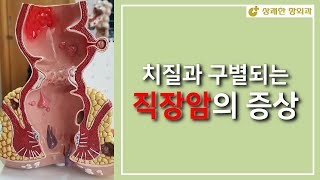 치질과 구별되는 직장암 증상 [upl. by Aikmat497]