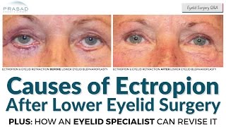 Causes of Ectropion after Lower Eyelid Surgery and Possible Restoration by an Eyelid Specialist [upl. by Adnamar]