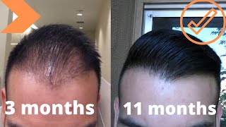 When To Expect Growth After A Hair Transplant My Timeline [upl. by Lacee]