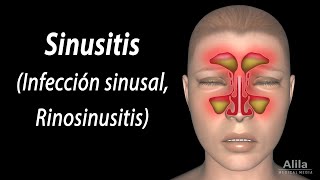 Sinusitis Animación Alila Medical Media Español [upl. by Jake]