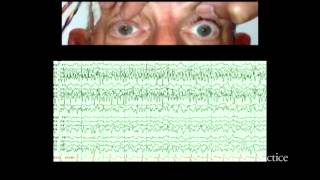 Alternating ictal and postictal nystagmus [upl. by Nnylg533]