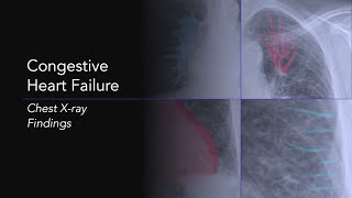 Congestive Heart Failure Explanation of Chest Xray Findings [upl. by Feriga]