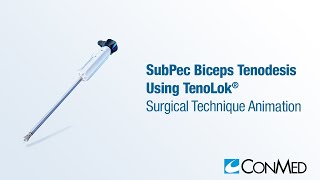 SubPec Biceps Tenodesis Using TenoLok®  CONMED Animation [upl. by Eilerua123]