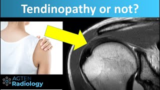 Tendinopathy Tendinosis of Rotator Cuff Tendons on MRI [upl. by Smallman]