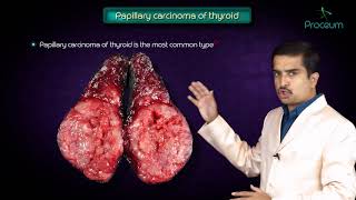 Most common thyroid cancer  Papillary thyroid carcinoma symptoms treatment and prognosis [upl. by Deutsch]