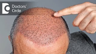 Side effects of Hair Transplant  Dr Vivekanand Bhat [upl. by Alik]