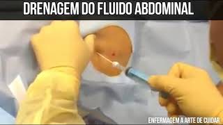 Drenagem do fluido abdominal PARACENTESE [upl. by Tucky913]