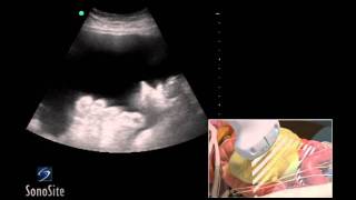 How To Ultrasound Guided Paracentesis Procedure 3D Video [upl. by Ettenel]