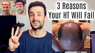 3 Reasons Your Hair Transplant Will FAIL [upl. by Amara]