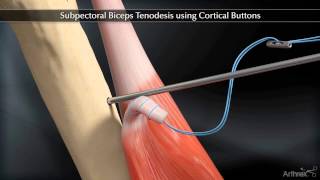 Subpectoral Biceps Tenodesis Using Cortical Buttons [upl. by Waylon466]