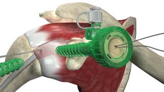 Biceptor Tenodesis System  Surgical Technique Walkthrough  SIMON MOYES [upl. by Ellekcir]