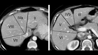TC do abdome Segmentação hepática [upl. by Anwahsiek]