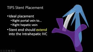 TIPS Stent US Doppler Evaluation [upl. by Avek]