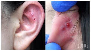 DONT WATCH THIS Piercing Removal If You Have A Weak Stomach 🤢 [upl. by Annorah]