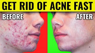 Say Goodbye to Acne Dr Bergs Proven Methods for Clearing Your Skin [upl. by Norud]