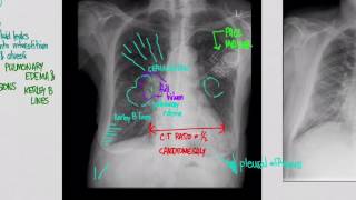 CXR Congestive Heart Failure CHF [upl. by Nagrom945]