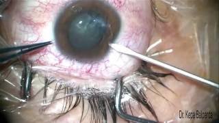 Ciruga de Trauma Ocular Penetrante – Dr Kepa Balparda [upl. by Rowan]