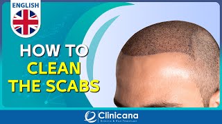 How to clean the scabs after 11 days from the hair transplant operation [upl. by Harvey]