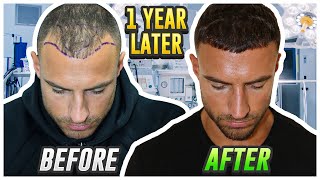 My Hair Transplant Results After 1 Year [upl. by Karole234]