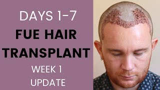 FUE Hair Transplant Week 1  Recovery healing sleeping itching swelling travelling [upl. by Wallraff]