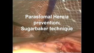 Parastomal Hernia Prevention Sugarbaker technique [upl. by Wiburg]