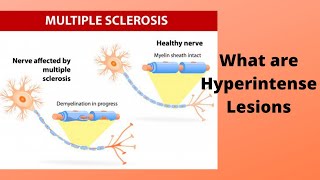 What are Hyperintense Lesions [upl. by Aile672]