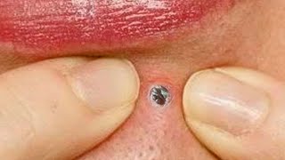 Dr Poppers Pimple Popping Extravaganza [upl. by Jarv]