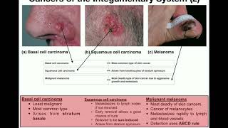 Anatomy  The Three Types of Skin Cancers [upl. by Eanat745]