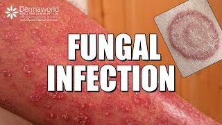 Suffering from Fungal Infection Ringworms WATCH THIS [upl. by Hannah]