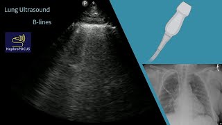 B lines on lung ultrasound before and after dialysis a POCUS case study  Dr Koratala NephroP [upl. by Ready]