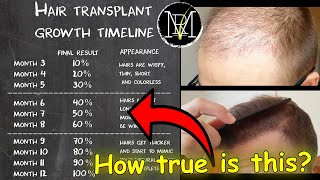 Hair Transplant growth timeline  Month 19  Norwood 5 [upl. by Letsyrhc]