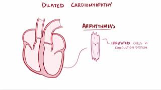 Dilated cardiomyopathy DCM causes symptoms diagnosis treatment amp pathology [upl. by Shirberg227]